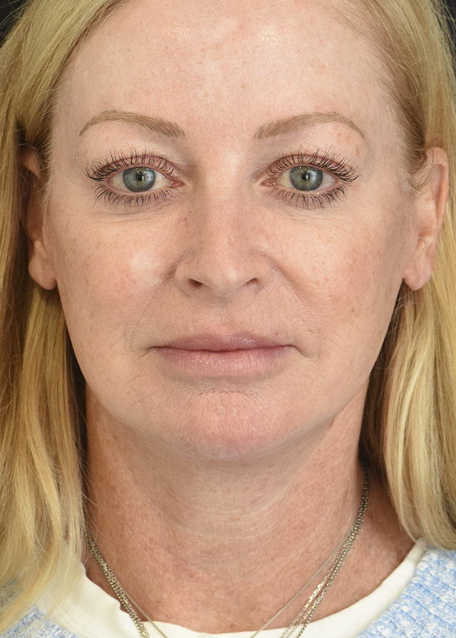 Deep Plane Facelift Patient 42 Set 1 After